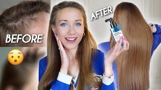 MY HAIR GROWTH STORY: Using L'OREAL AMINEXIL Hair Loss Treatment