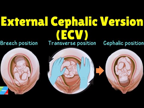 External Cephalic Version (ECV) - When is it used and how is it done?