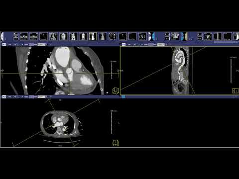 How to read an acute aorta protocol CT