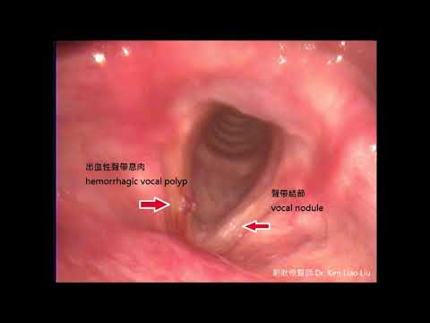 出血性聲帶息肉 Hemorrhagic Vocal Polyp