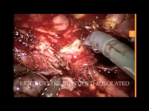 Robotic hysterectomy for endometriosis Dr Rooma Sinha Gynecologist Apollo Hospital