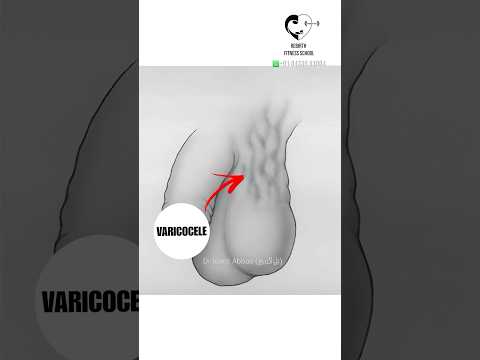 விரைப்பந்துகளில் பிரச்சனை- Varicocele | Dr. Isacc Abbas