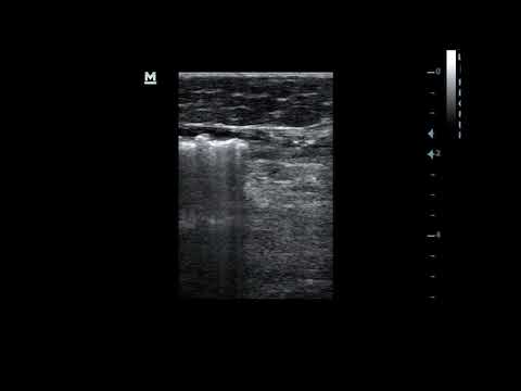 Insertion, deployment and laser ablation of Great saphenous Vein #shortsvideo