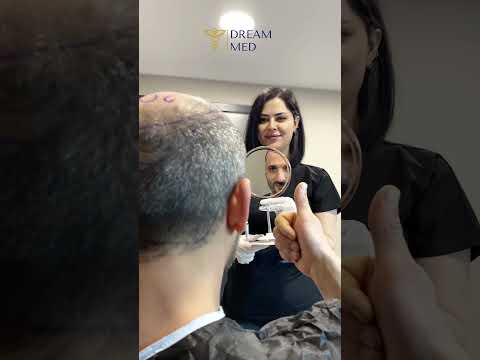 DREAM MED İLE SAÇ EKİMİ  #hairtransplant #sacekimi #greffedecheveux #hairtransplantturkey #dreammed