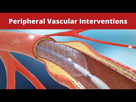 Peripheral Vascular Interventions