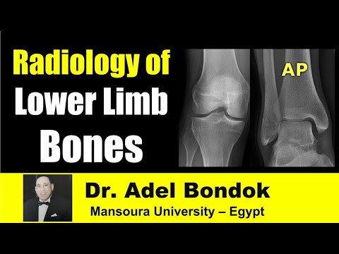 Radiological Anatomy of the Lower Limb Bones, Dr Adel Bondok