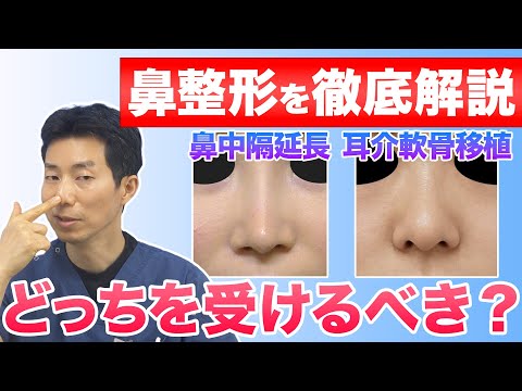 【鼻整形】鼻先は鼻中隔延長と鼻尖形成のどちらを受けるべき？