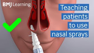 Teaching patients to use nasal sprays | BMJ Learning