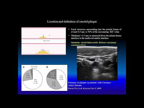 Evaluation of carotid plaque morphology with duplex ultrasound