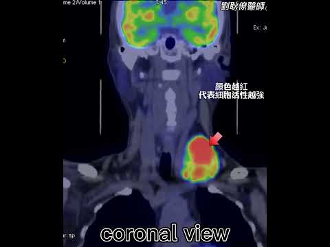 甲狀腺癌 正子電腦斷層掃描 thyroid cancer PET CT