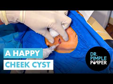 A Happy Cheek Cyst