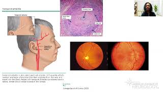 Virtual Resident Education Lecture Series: Headache Medicine - American Academy of Neurology