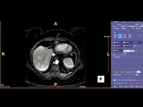 How to do Liver Volumes