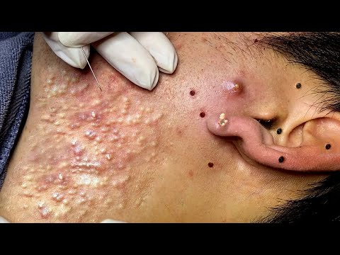 new this week pimple popping videos