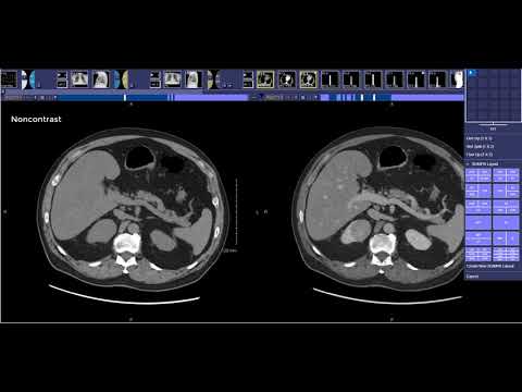 How to read a Renal Mass CT