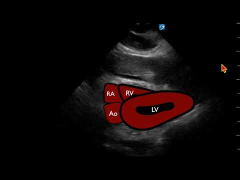 POCUS: Cardiac - Misdiagnosis for Asystole