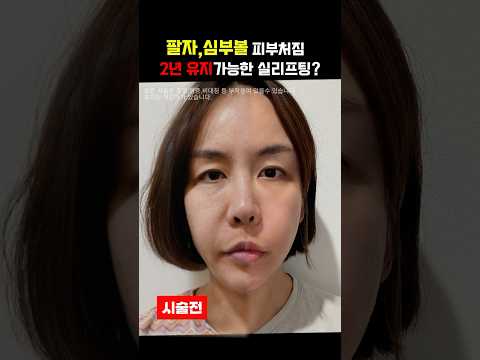 실 리프팅 한 번이면 2년 동안 팔자주름, 심부볼  걱정이 끝!? #실리프팅  #주름