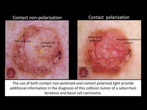 Collision Tumors - Dr. Margaret C. Oliviero