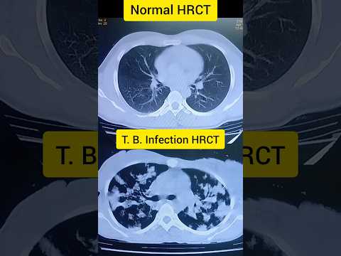 Normal HRCT 🆚 Abnormal HRCT