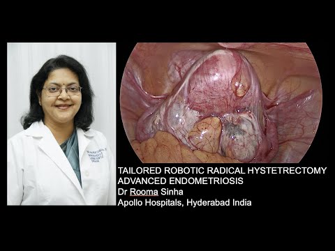 Tailored Radical Robotic Hysterectomy for Advanced Endometriosis with narration