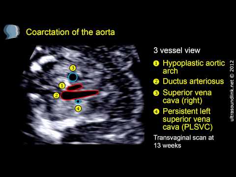 Coarctation of the aorta: 12 weeks fetus