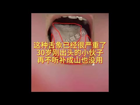 这种舌象真是没救了30岁刚出头的小伙子 再不听 补药成山也没用