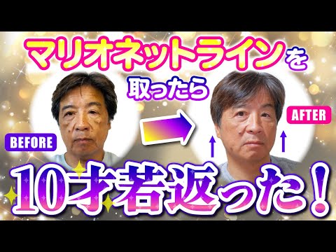 【おじさんだって綺麗になりたい！】糸リフトをいれてマイナス10才の若返りに成功！？ #おじさん整形 #整形 #リフトアップ