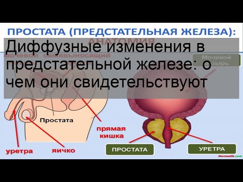 Диффузные изменения в предстательной железе: о чем они свидетельствуют