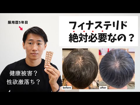 【薄毛改善】AGA治療にフィナステリドは絶対に必要なのか？副作用（性欲減退・肝機能障害）のリスクと代替案について本気で考えてた。