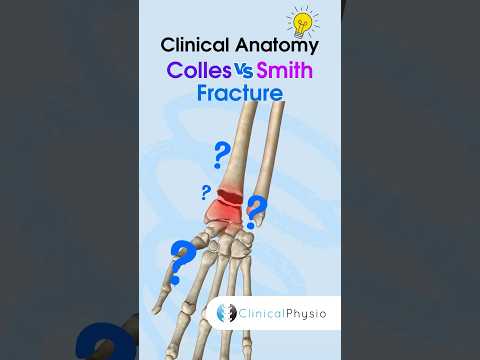 Colles vs. Smith Fracture #physicaltherapy #physiotheraphy #fracture #wrist