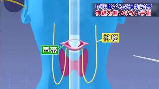 治る最前線「甲状腺がんの最新治療2」