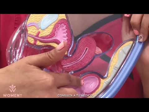 ¿Te duele cuando reglas? Descubre si tienes o no endometriosis.