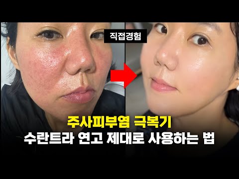 수란트라 연고 제대로 사용하는 법 모두 공개, 주사피부염 이렇게 극복 했어요