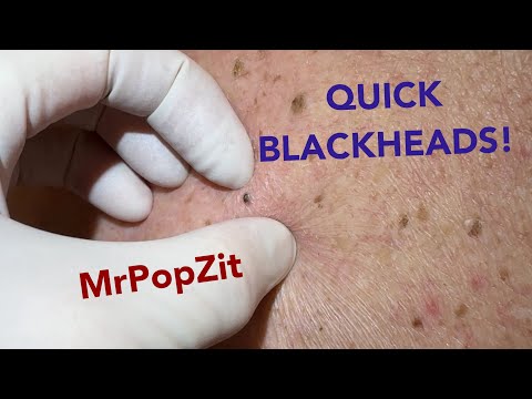 Quick and easy blackhead extractions!! Imbedded plugs removed with ease!