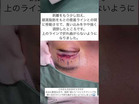 広くしてしまった全切開二重を全切開術で狭くする！