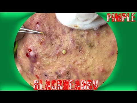 The Pimple Remove - Popping Videos - Blackheads 2019 #15