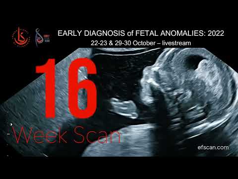 16 Week Anomaly Scan - EARLY DIAGNOSIS of FETAL ANOMALIES 2022