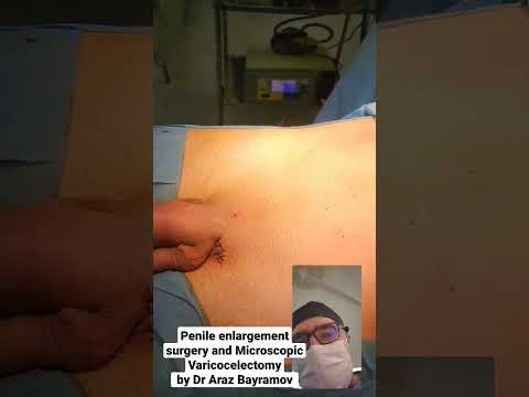 Penile enlargement surgery and Microscopic Varicocelectomy by Dr Araz Bayramov #andrologist #penis