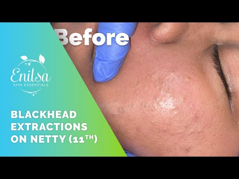 Blackhead Extractions on Netty - 11th Treatment