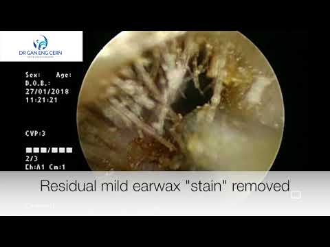 Aural toilet - Ear cleaning under scope guidance