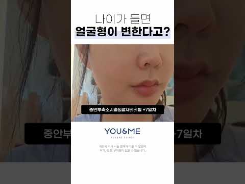 중안부가 처져서 얼굴이 길어졌다면?