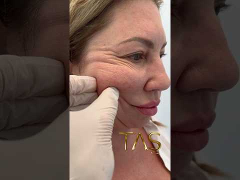 20 Years Back with Scarless Facelift by Prof.Dr.Suleyman Tas #facelift #drsuleymantas