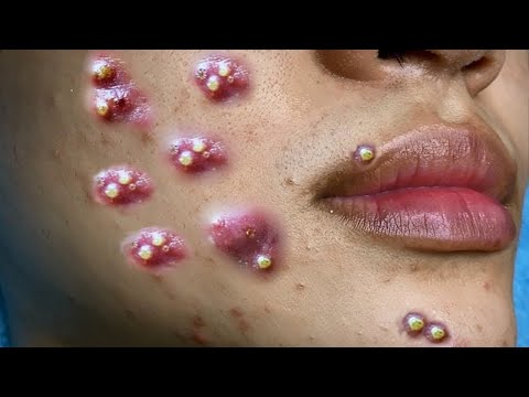 Make your Acne Treatment  | 444# Part 1 | acne 2022