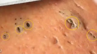 (7 Intense Blackhead Removal videos) | Poppy TV Ep#6 | viral video compilation