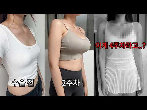 가슴수술 전후사진 공개💥 부모님 몰래 하는 가슴 수술.. 근데 결과가..?😅 [은채1Vlog]