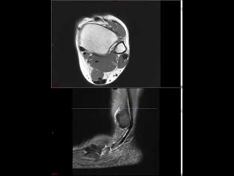 Ankle MRI (Approach to MSK MRI Series)