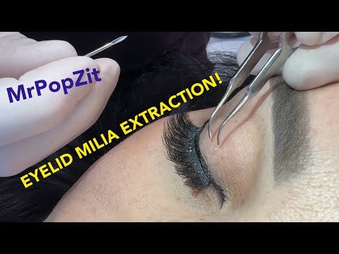 Eyelid MILIA removal. Soft touch required. Patient so happy, it was there a long time!