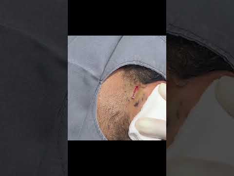 An Ear Cyst You Don't Want to Miss!