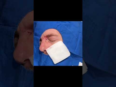 Eye See You Cyst