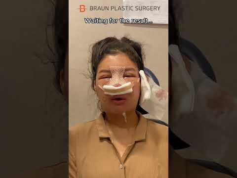 I cried when watching this...😭 #fyp #glowup #facialcontouringsurgery #rhinoplasty #plasticsurgery